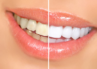 Teeth Whitening Marana